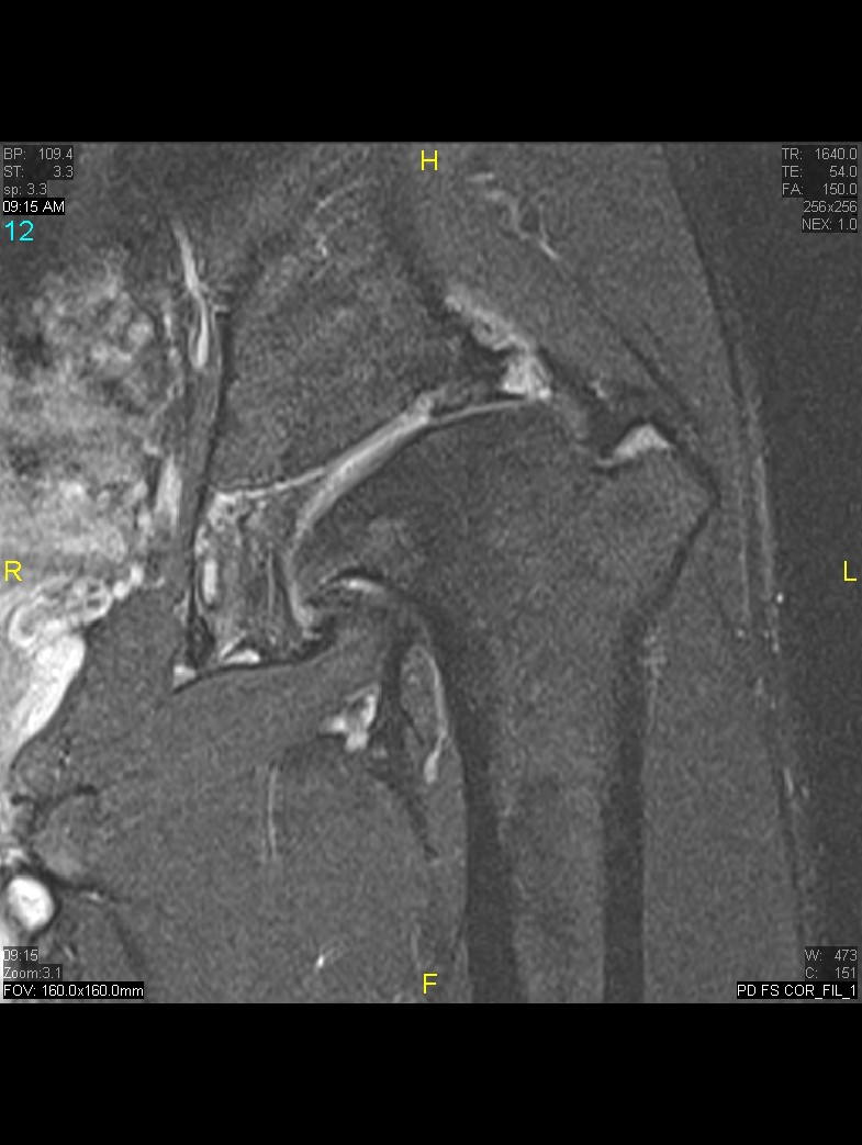 Figure 8 for case History Perthes Disease